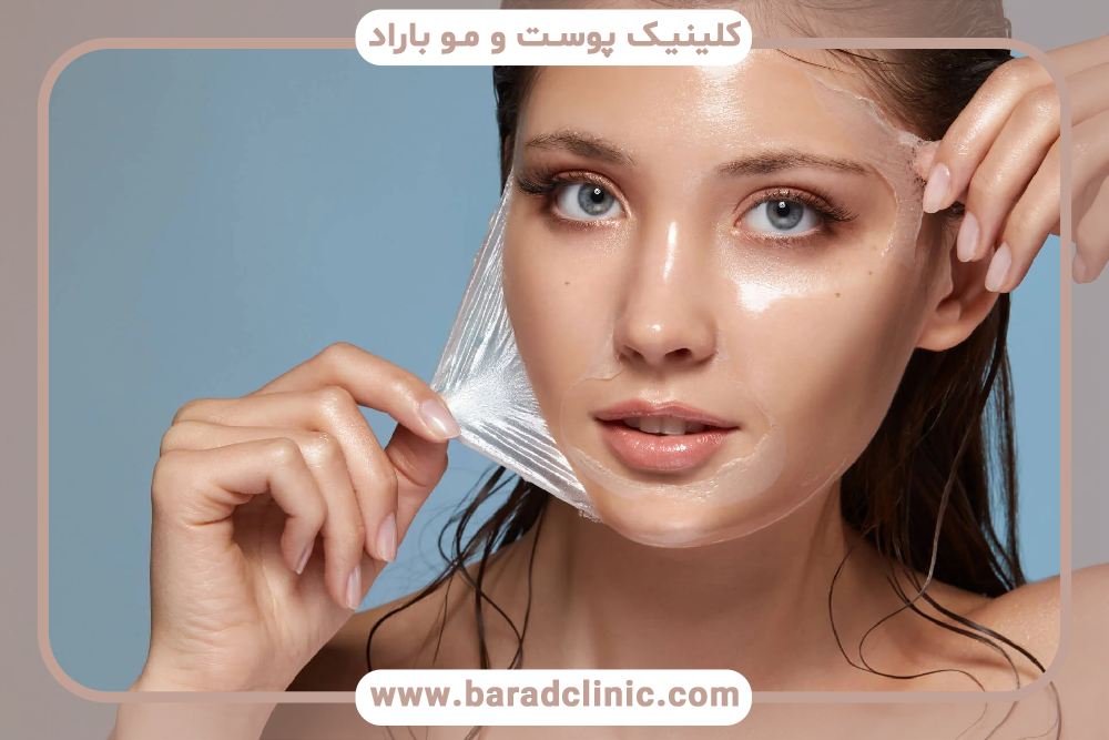 لایه برداری شیمیایی