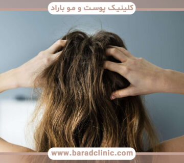 ریزش مو