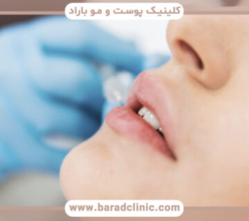 روشهای رفع افتادگی گوشه لبها چیست؟