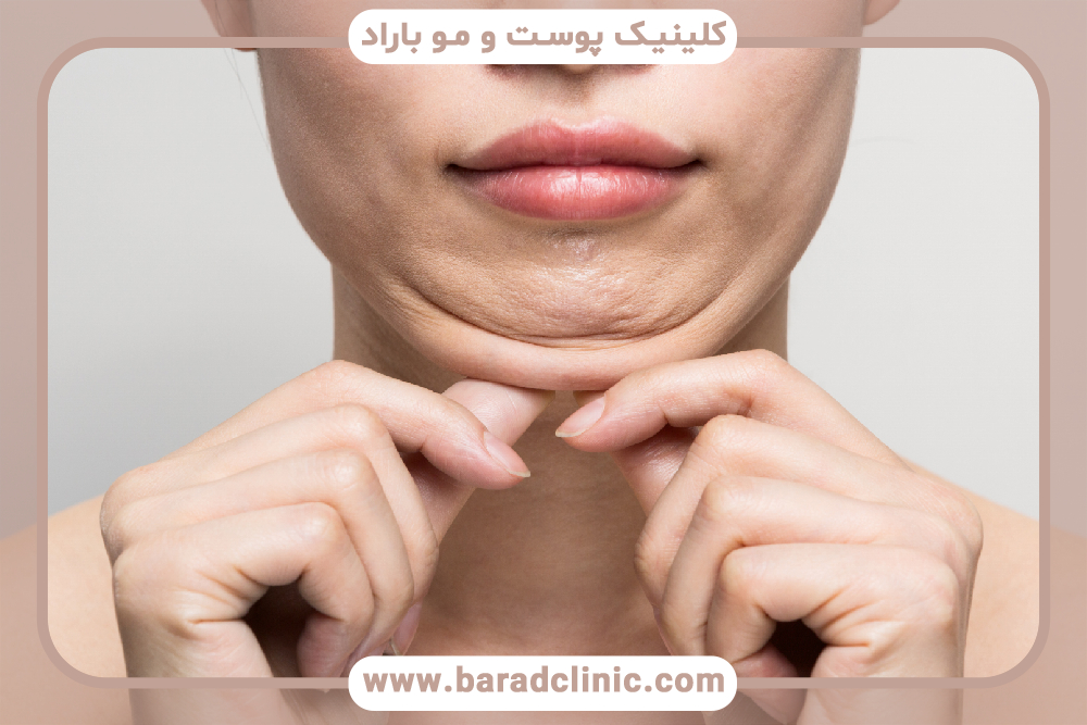 ساکشن غبغب و تاثیر آن بر روی خطوط ریز صورت و چین و چروکها