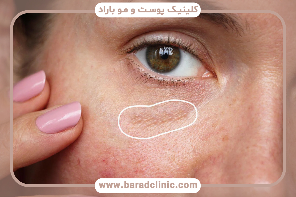 میلیا چیست؟ راه‌های درمان میلیا چیست؟