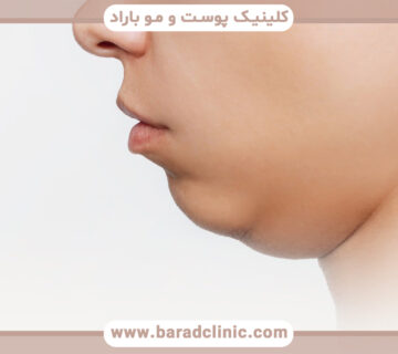 عوارض جانبی ساکشن غبغب و نحوه مدیریت آنها