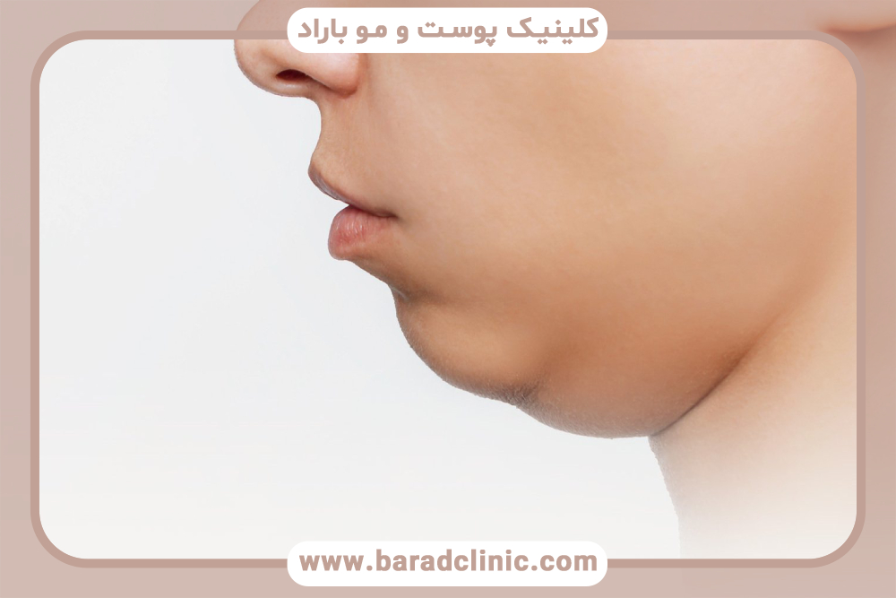 عوارض جانبی ساکشن غبغب و نحوه مدیریت آن‌ها