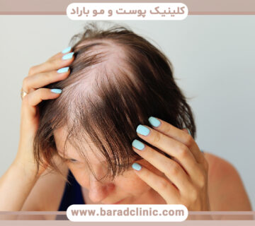 چه چیزی باعث طاسی در زنان میشود؟