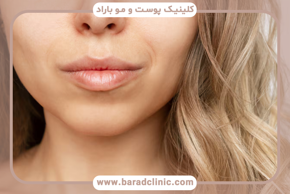 توصیه‌های پیش از عمل بوکال فت برای به دست آوردن نتایج بهتر