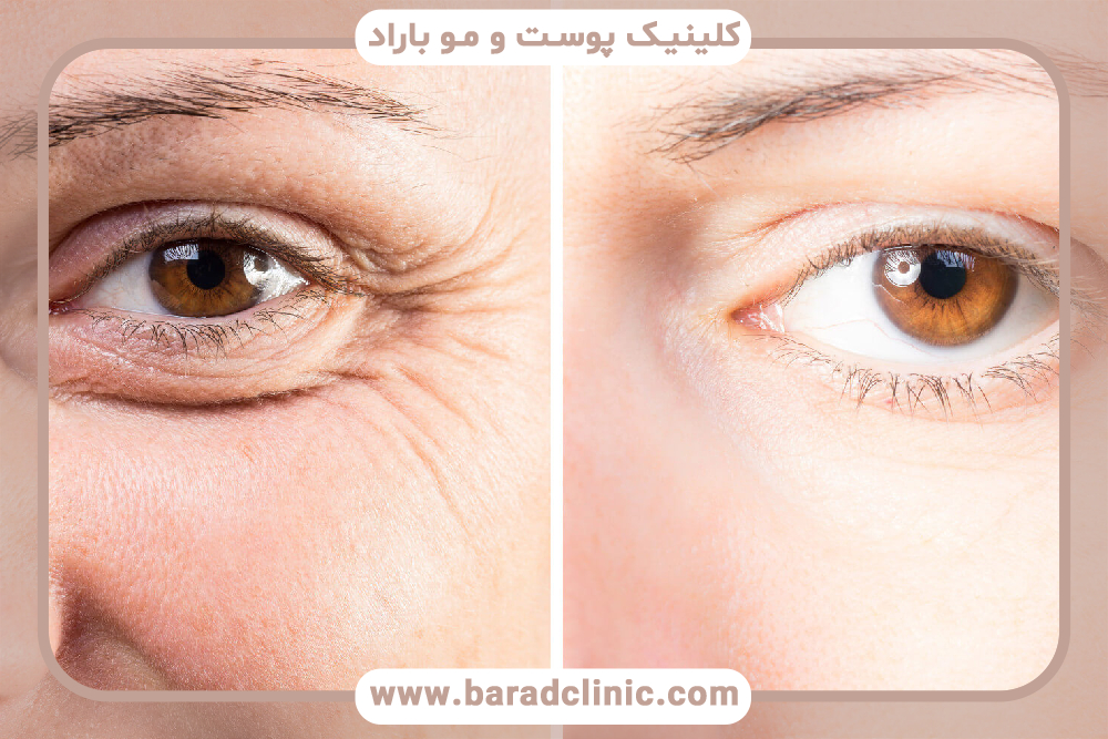 هزینه بلفاروپلاستی