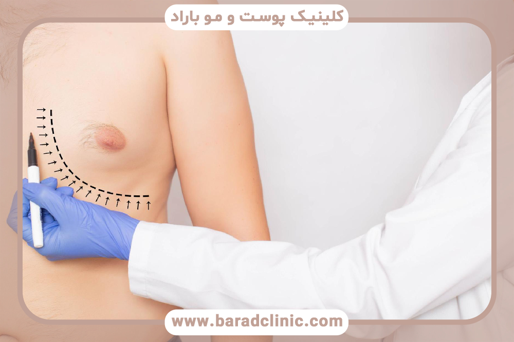 جراحی ژنیکوماستی