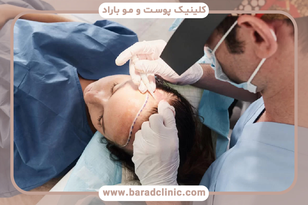 درمان کاشت مو