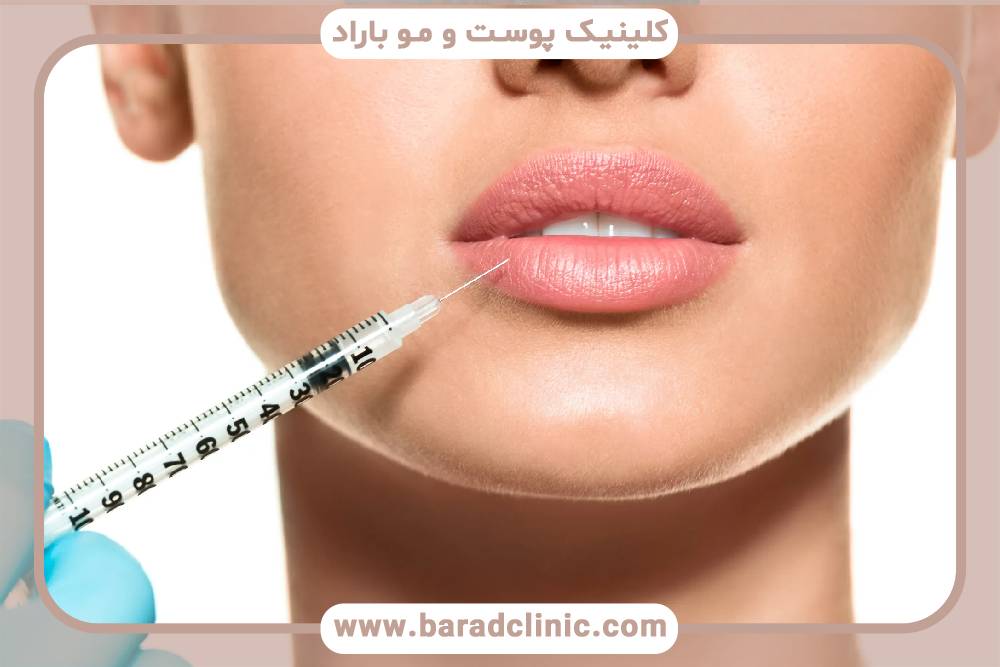 انتخاب روش مناسب برای تزریق فیلر لب انتخاب روش مناسب برای تزریق فیلر لب