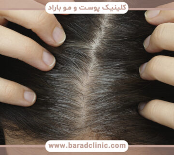 سفید شدن مو در سنین پایین