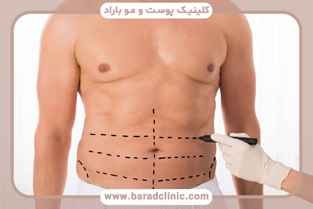 تکنیک‌های کاهش تورم پس از لیفت بدن