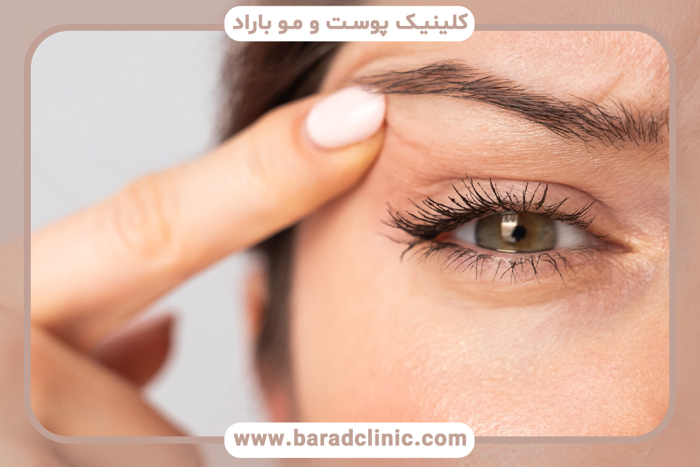 آشنایی با تکنیک‌های جدید در بلفاروپلاستی