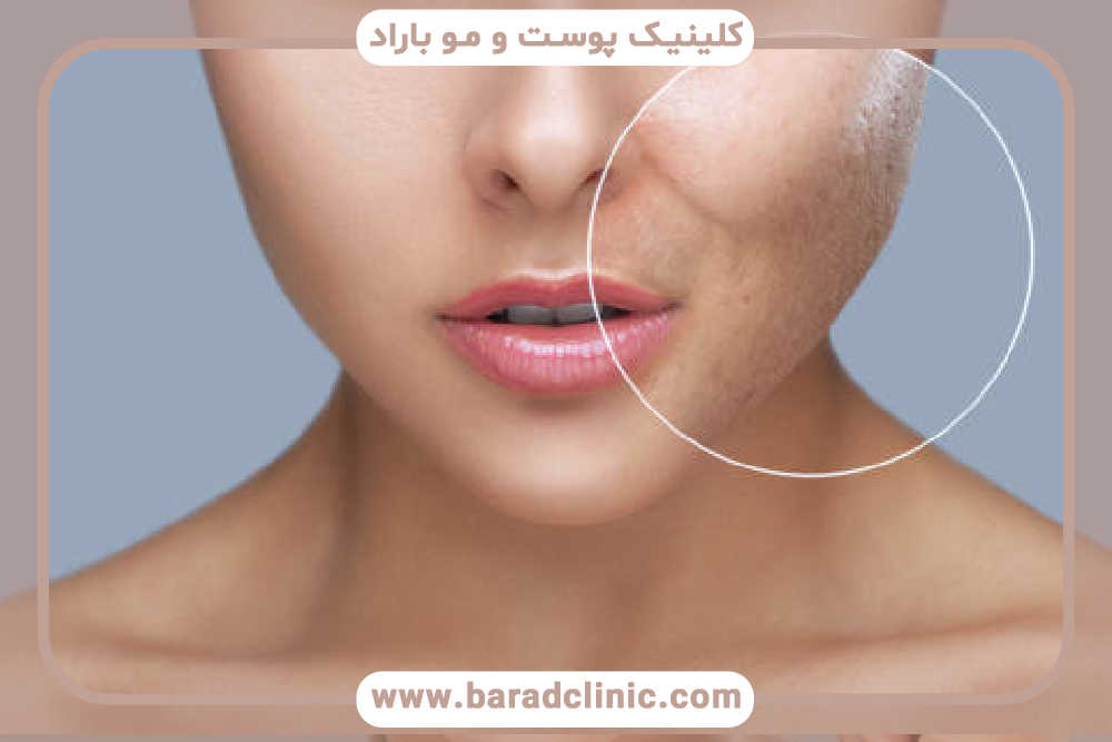 جراحی برای ترمیم جای آکنه