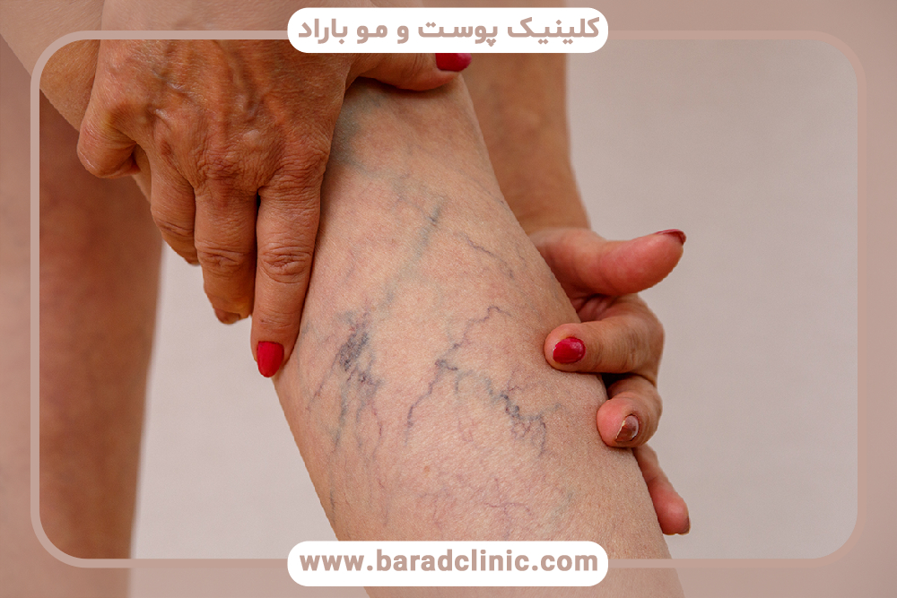 رگ‌های عنکبوتی