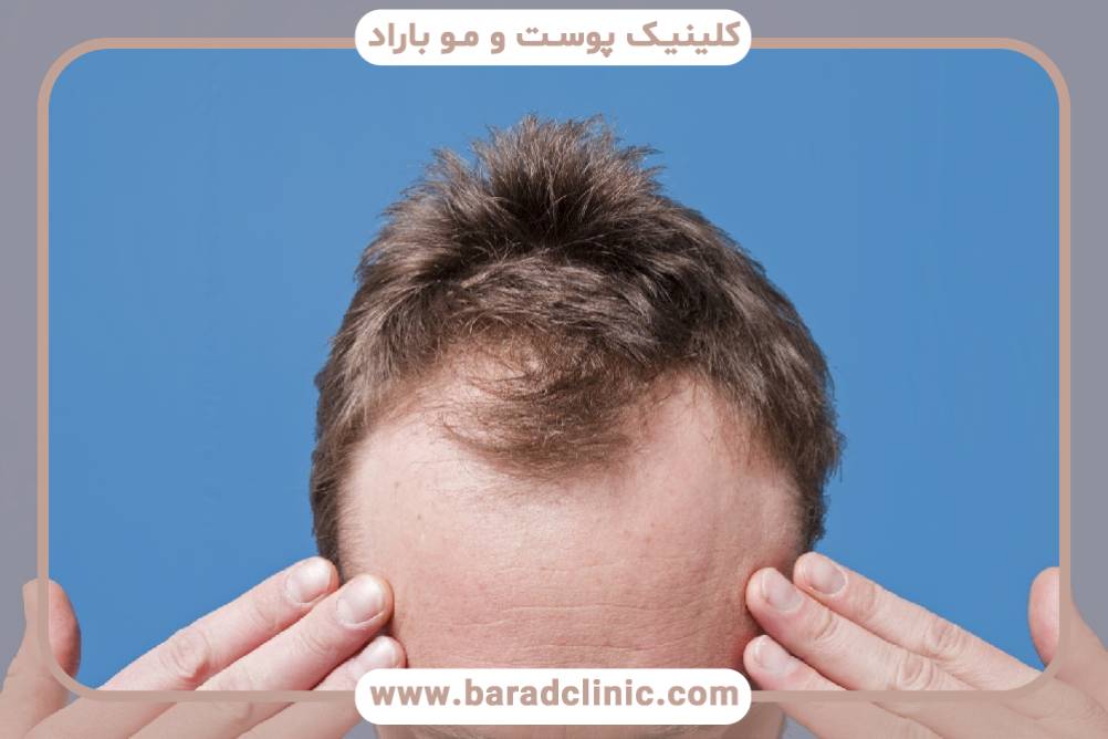 شست و شوی موی کاشته