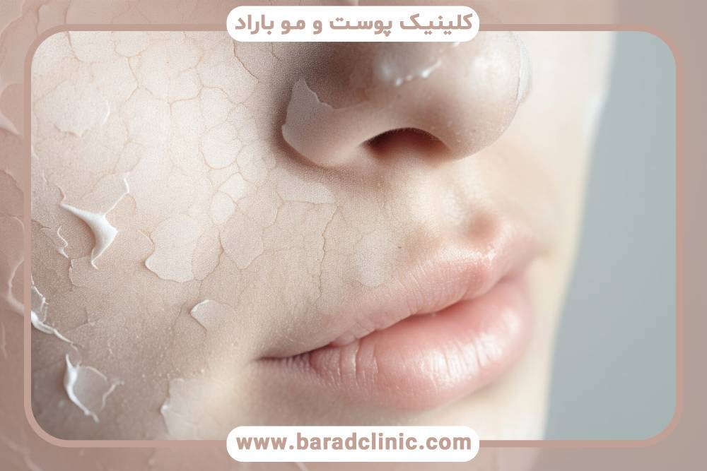 مقایسه لایهبرداری قوی و میکرودرم ابریژن