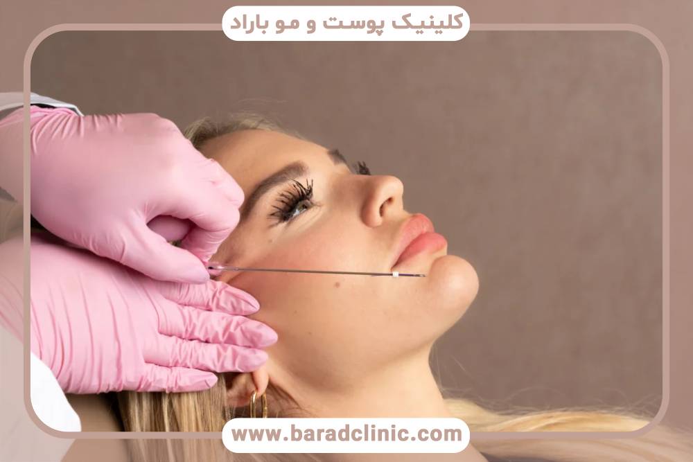 روش لیفت صورت با نخ چیست؟ و چه مزایایی دارد