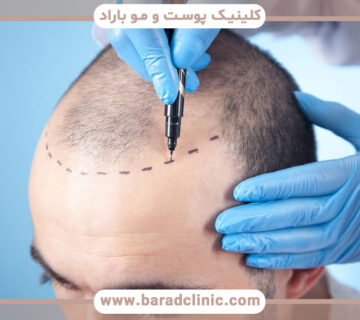 دلمههای بعد از کاشت مو