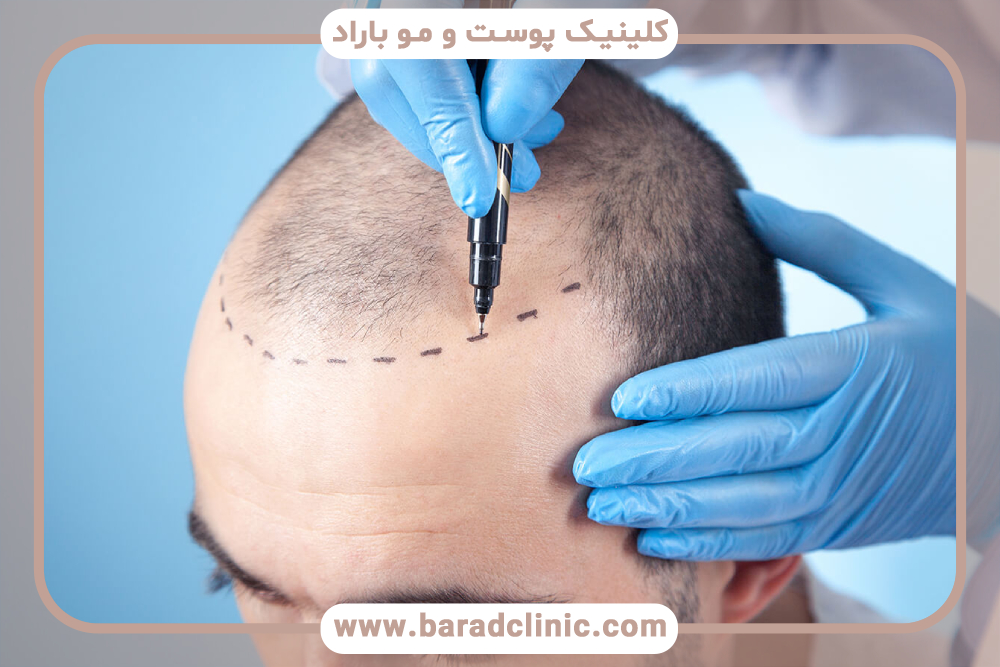 دلمه‌های بعد از کاشت مو