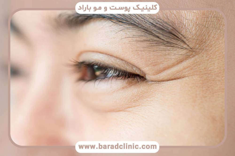 بهترین درمان برای رفع خطوط پنجه کلاغی بدون جراحی