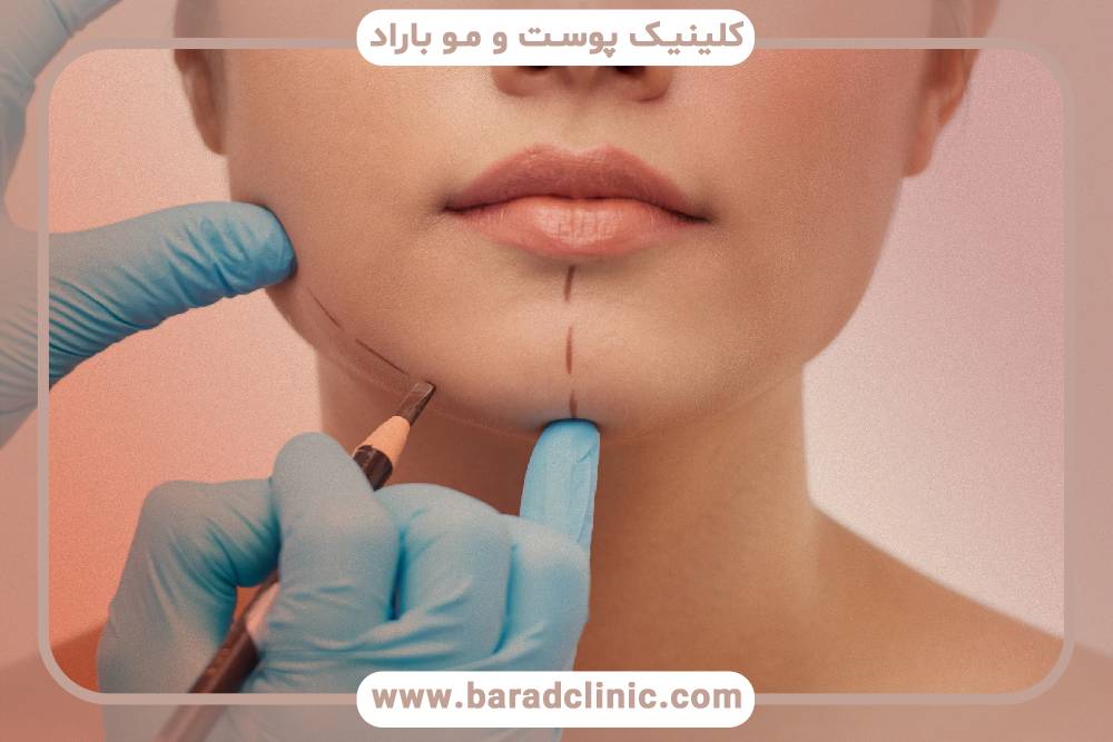 لیفت صورت ترند