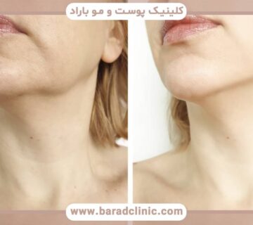 تفاوت بین بوکال فت و سایر روشهای کاهش چربی صورت