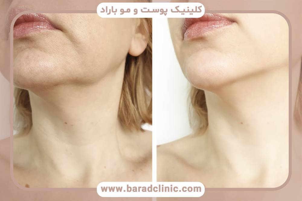 تفاوت بین بوکال فت و سایر روش‌های کاهش چربی صورت