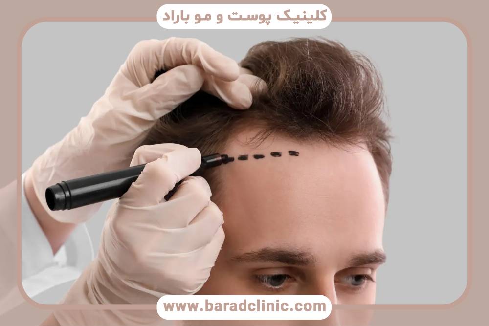 جراحی کاشت مو رباتیک (ARTAS) چگونه کار می کند