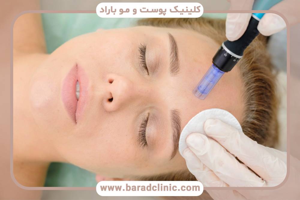 بررسی چند مزیت درمان میکرونیدلینگ