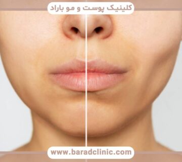 تکنیکهای جدید در بوکال فت