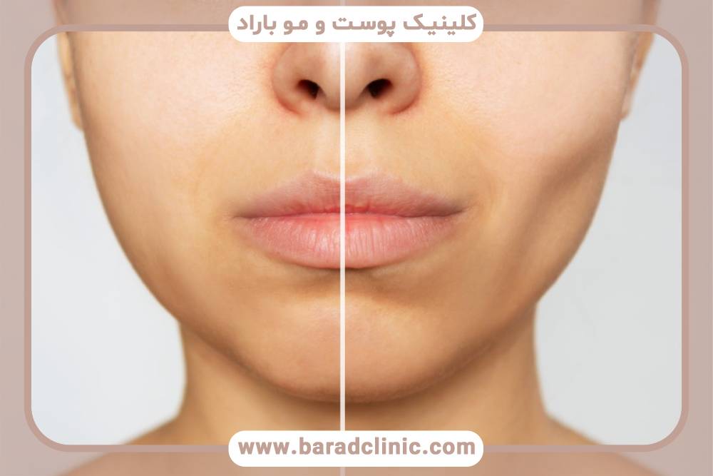 تکنیک‌های جدید در بوکال فت