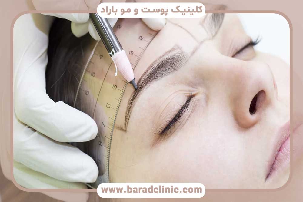 Shedding after eyebrow transplant