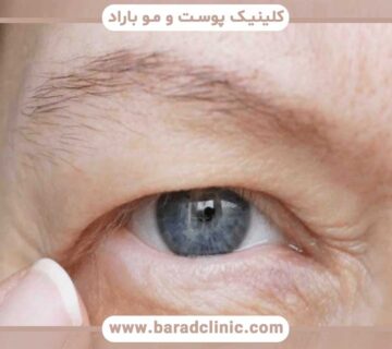 drooping eyelid