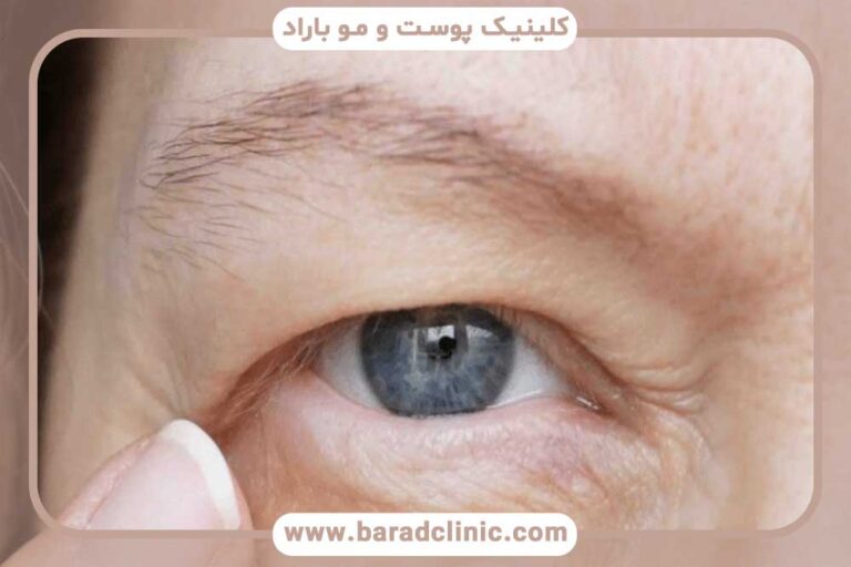 drooping eyelid