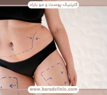 هر آنچه باید پس از جراحی لیفت ران بدانید