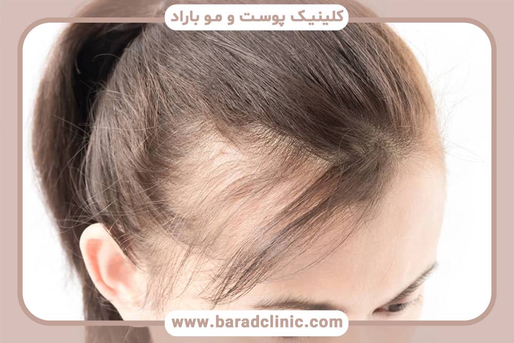 بهبود موهای نازک