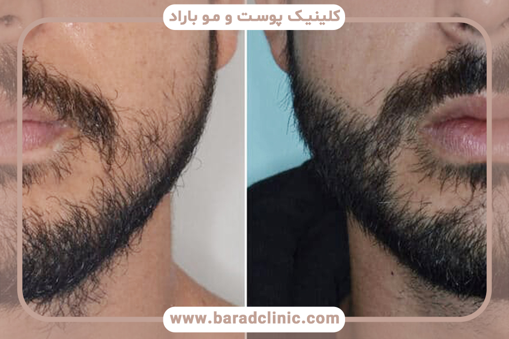کاشت ریش