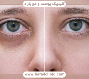 فیلر زیر چشم