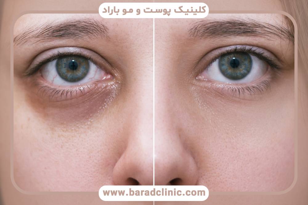 فیلر زیر چشم