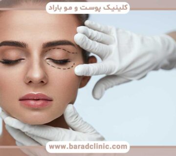 Dimple under the eye after blepharoplasty