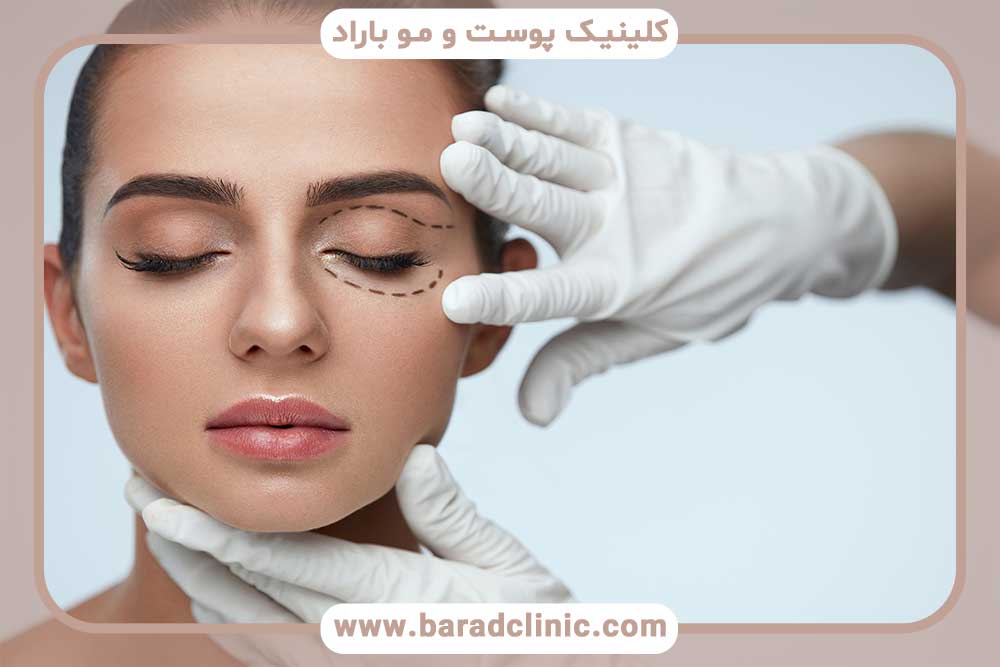 Dimple under the eye after blepharoplasty