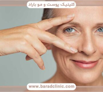 Blepharoplasty recovery period