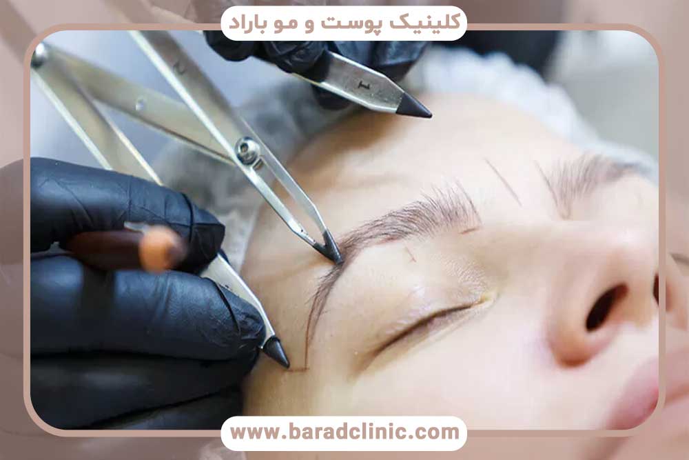 Bath and after eyebrow transplant