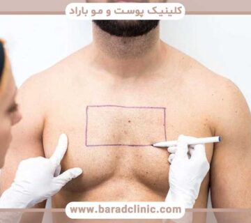Hair transplant from body to head