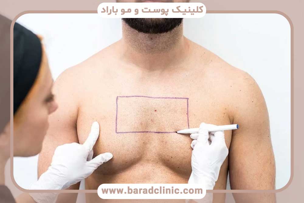 Hair transplant from body to head