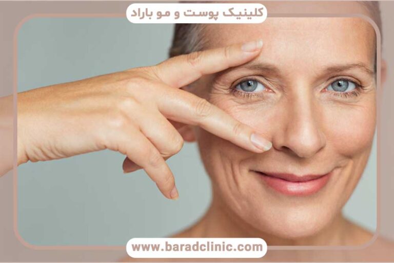 Blepharoplasty recovery period