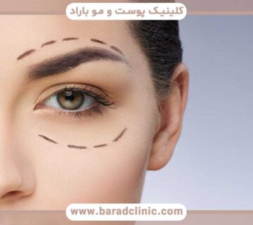 blepharoplasty