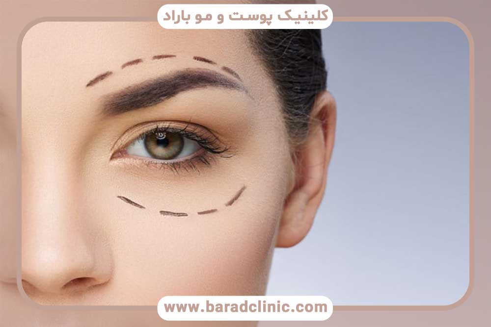 عمل بلفاروپلاستی چشم یکی از عمل‌های زیبایی است