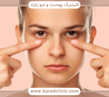 حلقه های تیره زیر چشم