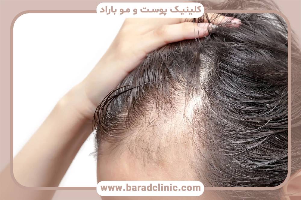 عقب رفتن خط مو